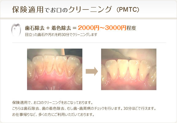 保険適用で歯のクリーニング